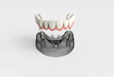 Riabilitazione completa All-on-4